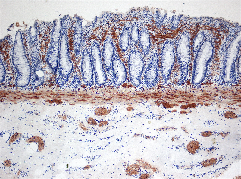 Histopatología de la enfermedad de Hirschsprung. Wikimedia Commons